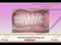 Que son los implantes dentales